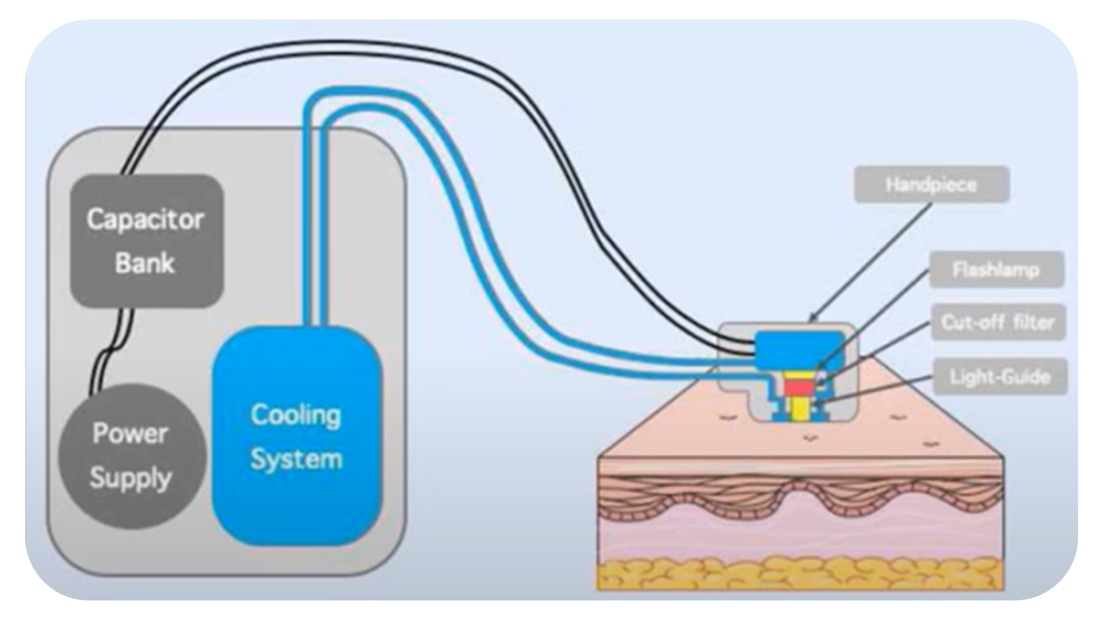 IPL devices technology scheme