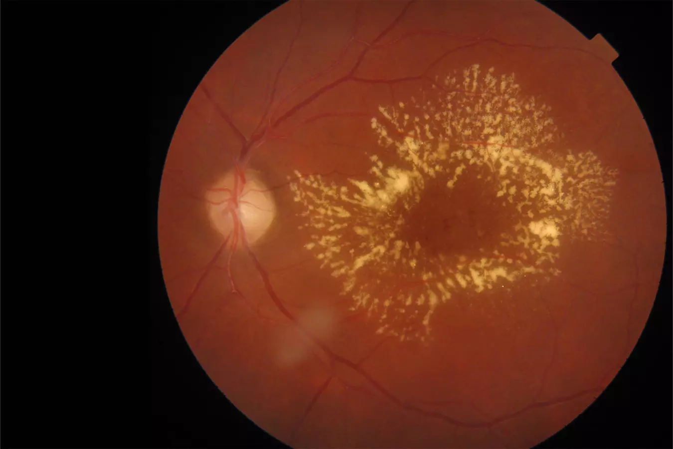 macular-telangiectasia-subliminal-laser-treatment-648c6f2247cb0540111715.webp