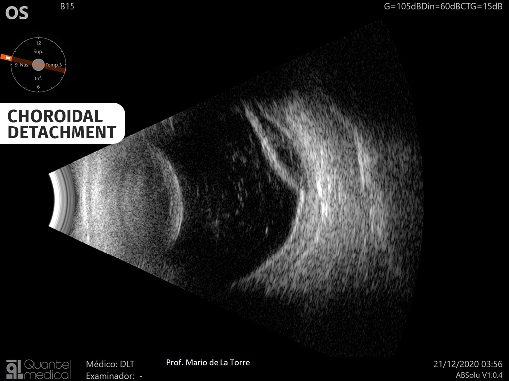 choroidal-detachment-63bd7bcfe5eb3680808075.jpg