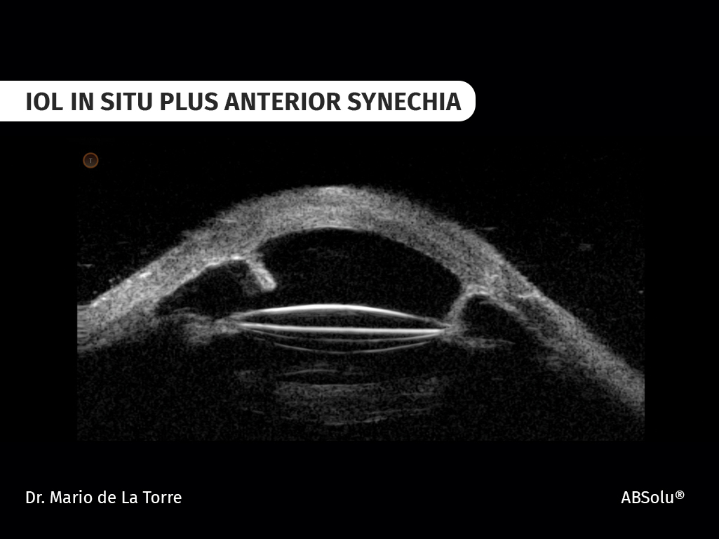 iol in situ plus anterior synechia