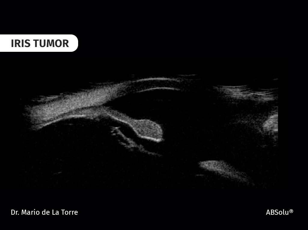 iris tumor
