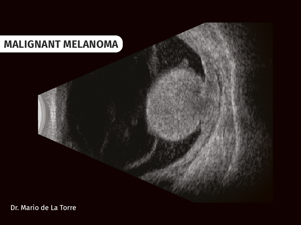 malignant-melanoma-66e8163ecfece476800907.jpg