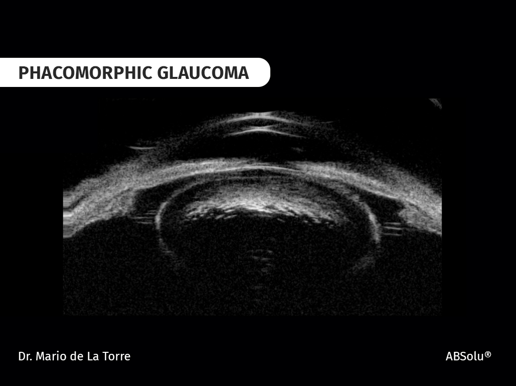 phacomorphic glaucoma