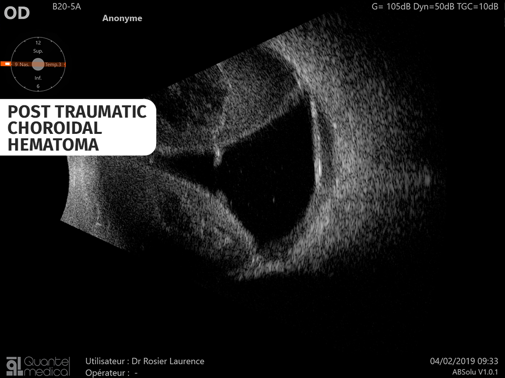 post-traumatic-choroidal-hematoma-63bd79579ad1c629673332.jpg