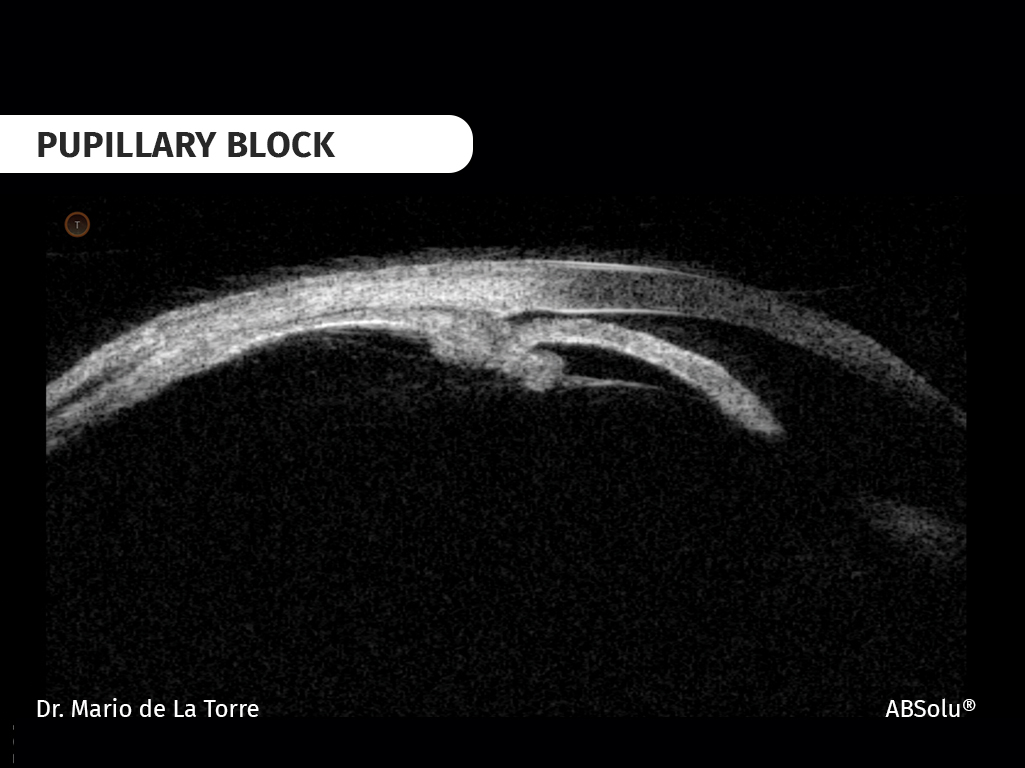 pupillary block