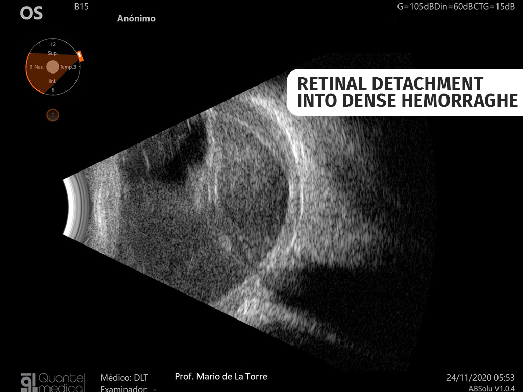 rd-into-dense-hemorrhage-63bd8240c8bdb157694469.jpg