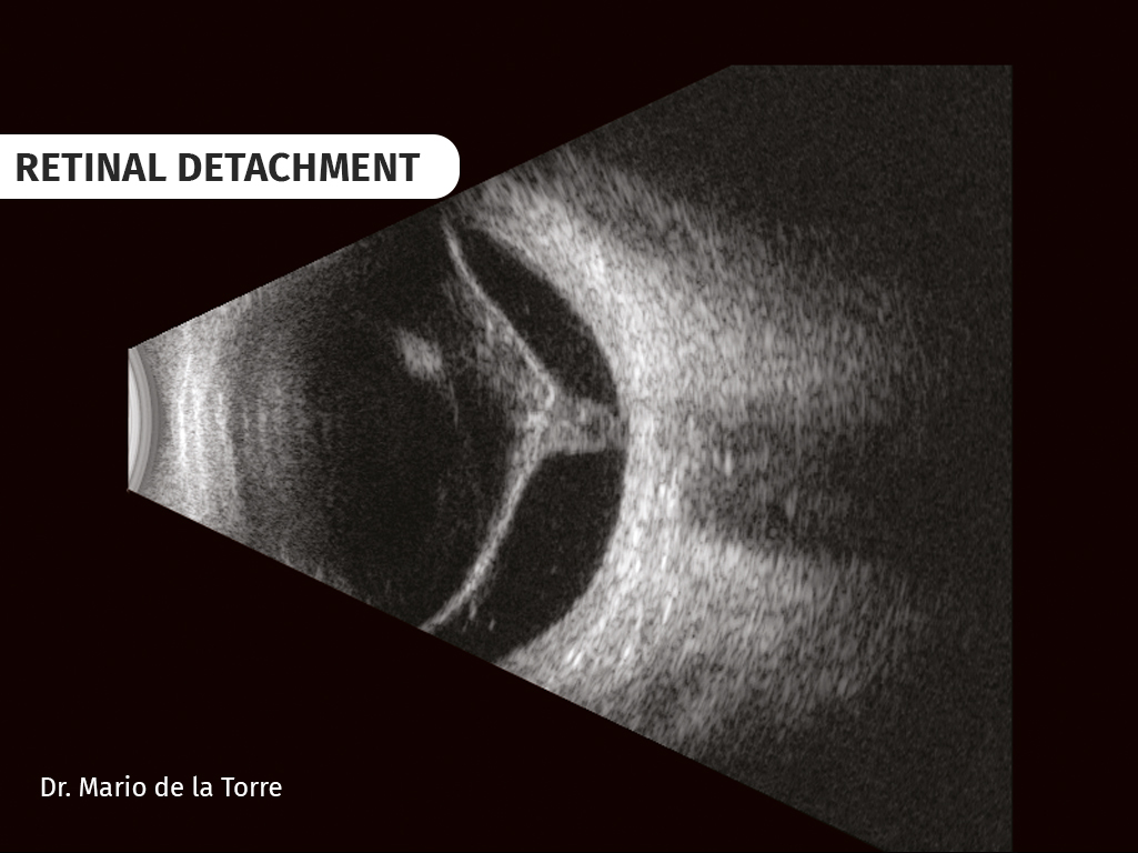 retinal-detachment-2-66e8163ecfad2743087123.jpg