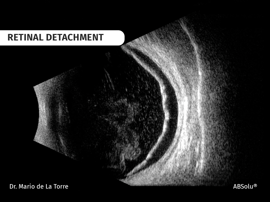 retinal-detachment-absolu-66f2743364a08639309674.jpg