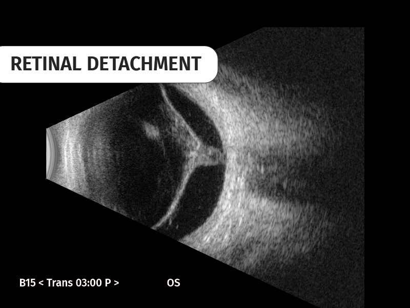 retinal-detachment-left-2-655604059b288412718179.png