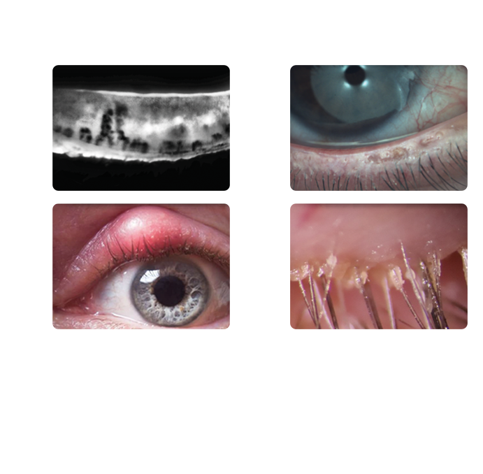 treat the root cause of dry eye
