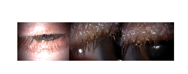 demodex1 63b40bd0733b3560512351 2