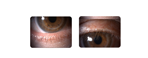 demodex3 3