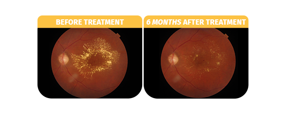 <p>SubLiminal<strong>®</strong> Laser Treatment</p>