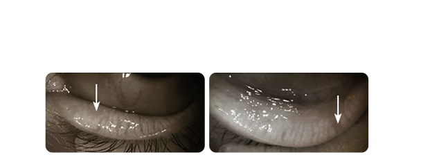 ocular exam lacrydiag 1