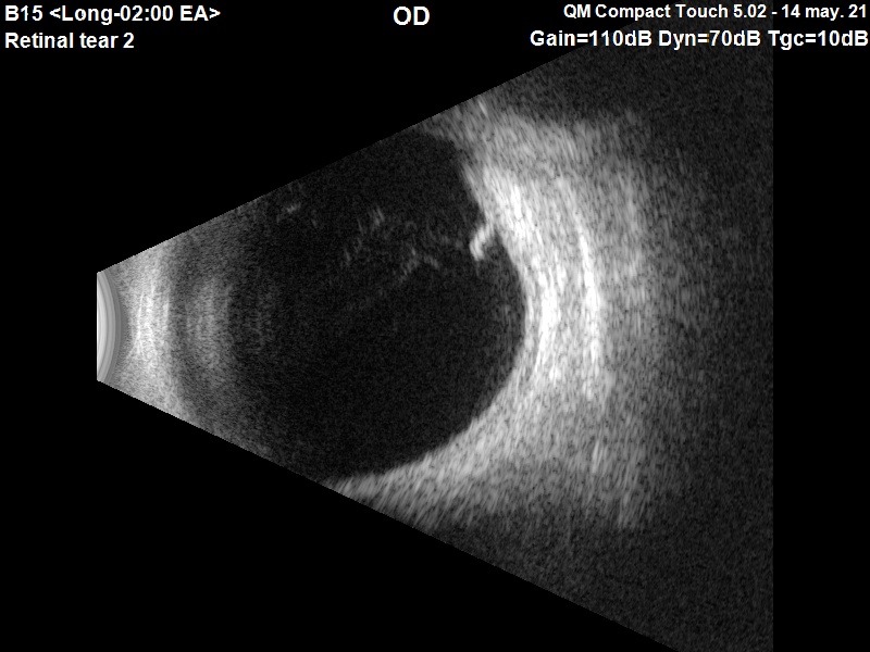 <p>Opcje diagnostyczne - USG oczu</p>